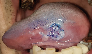 Diagnostic Complexities of Oral Squamous Cell Carcinoma