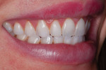 (3. AND 4.) Pretreatment right and left lateral smile photographs showing the tight anterior relationship.