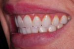 (3. AND 4.) Pretreatment right and left lateral smile photographs showing the tight anterior relationship.