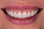 (10.) Provisional restorations (Luxatemp [Bleach Light], DMG America) were placed to permit assessment of the new tooth and tissue alterations in the smile.