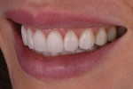 (11. AND 12) Right and left lateral smile photographs of the provisional restorations.