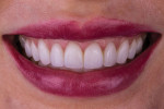 (16.) Posttreatment full smile photograph demonstrating a longer, fuller smile with proper function.