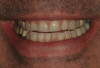 Figure 1  Use of gingival protector during the finishing of a cervical restoration to prevent trauma to the gingiva.