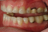 Figure 4  Final composite restorations with respect to upper right incisors.