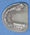 Figure 2. Lingual border showing placement of fiducial markers.