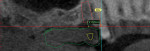 Figure 10. Implant No. 4 placed 2.02 mm below cementoenamel junction of No. 5.