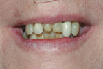 Exaggerated smile to evaluate gingival dispay