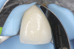 Fig 16. Removal of excess composite material using a #12 scalpel after ﬁnal polymerization.