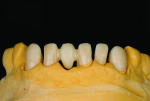 Fig 3. An opacified zirconia is chosen for the case because of the underlying shade of the prepared teeth.