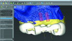 Fig 1. Surface scans (STL) and volumetric data (DICOM) are combined to provide a “Dental GPS” prosthetic plan.