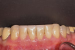 (5.) Lower anteriors after transitional composite
bonding.