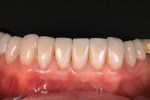 (7.) Placement of the final porcelain restorations, Nos. 20 through 29.