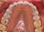 (8.) Upper occlusal shot to display stable centric stops and posterior disclusion by way of anterior guidance.