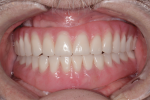 Fig 12. Note the final intraoral view of prosthetics.