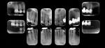 Preoperative full mouth series set of radiographs.