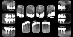 Postoperative full mouth series of x-rays.