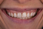 Pretreatment smile photograph showing composite veneers that were placed more than 10 years ago to cover facial erosive lesions.